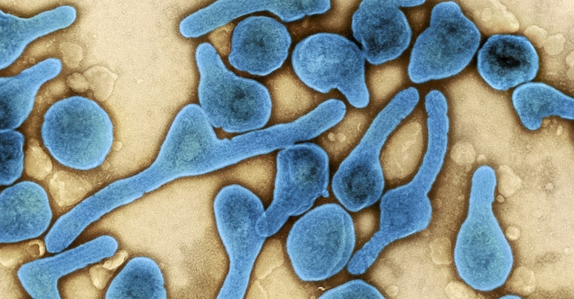 Hepatitis A ist eine durch Viren verursachte Entzündung der Leber.